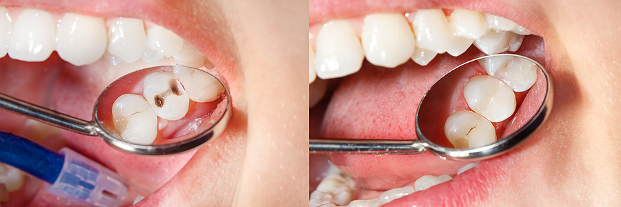 A Complete Guide to Composite Fillings in Fairbanks, AK: Benefits, Procedure, and Aftercare
