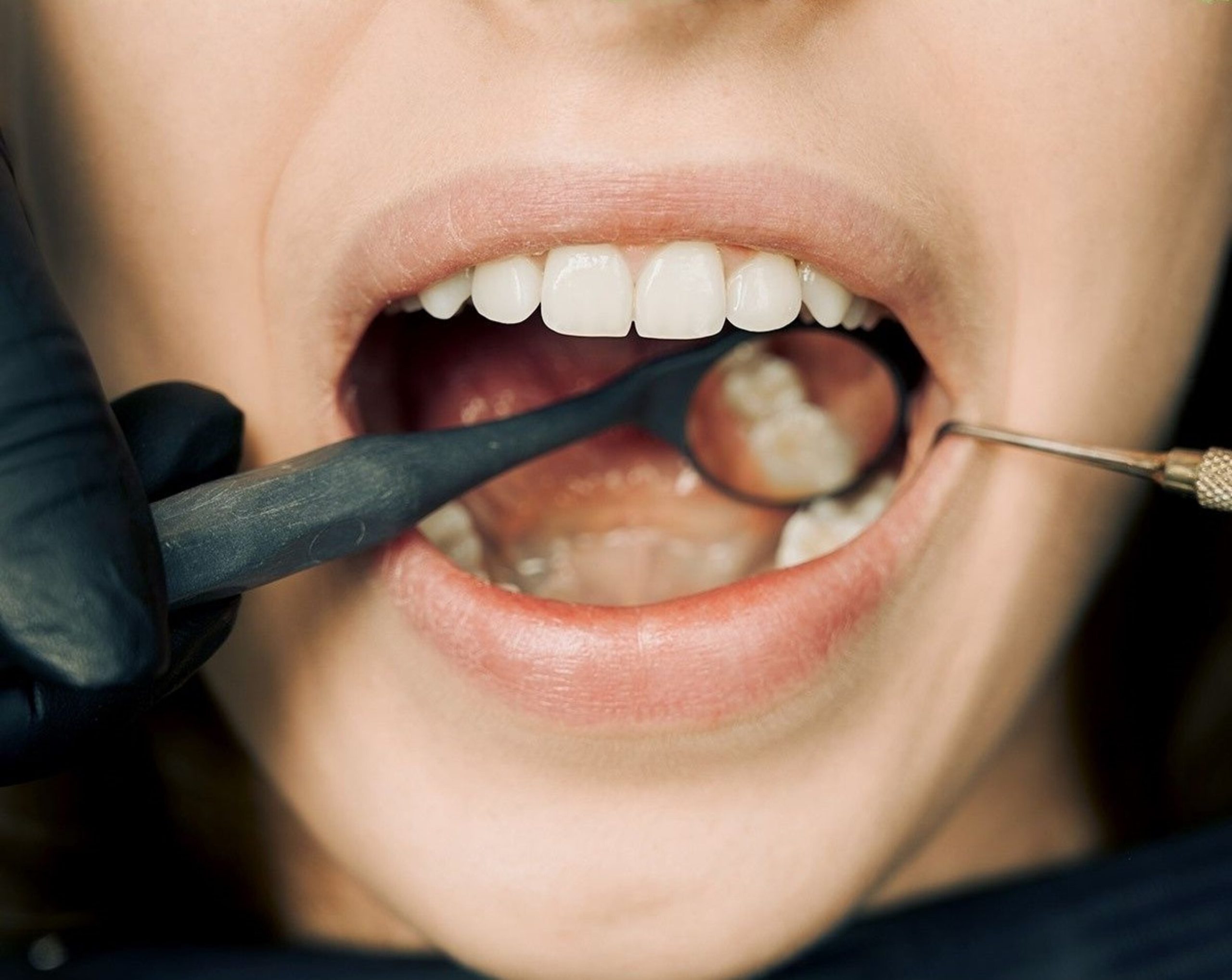 The Benefits of Fluoride Treatments